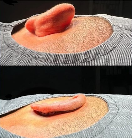 Septoplasty